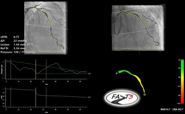 Pie Medical Imaging announces enrollment completion of the FASTIII clinical trial