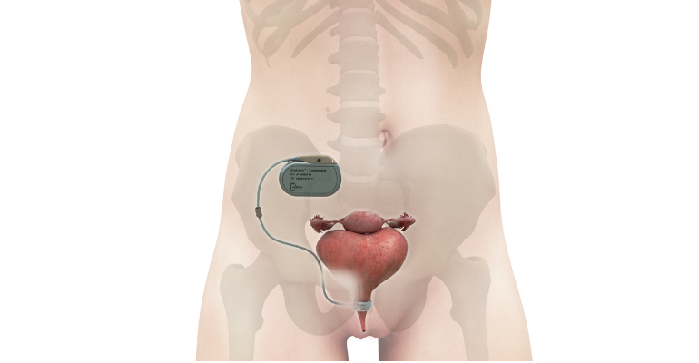 Behind the Design: Automated Artificial Urinary Sphincter Implant