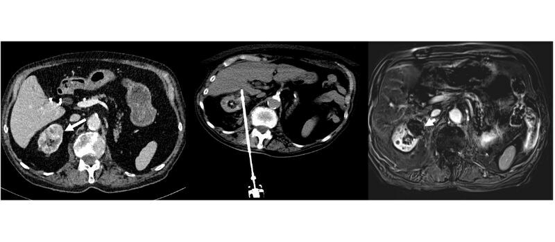 IceCure System Successfully Treated Kidney Cancer Tumor with 92% Disease-Free Survival Rate and 100% Secondary Local Control Rate