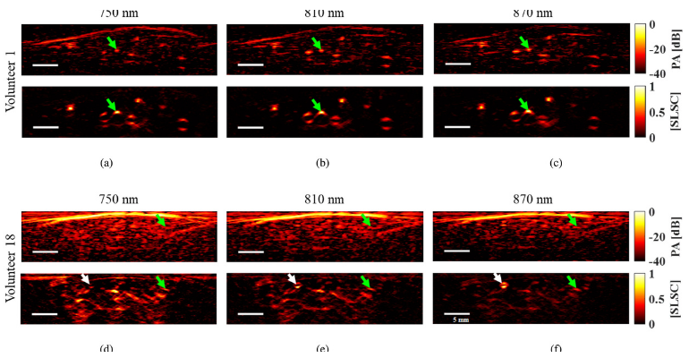 Study: SLSC Photoacoustic Imaging to Reduce Skin Tone Bias