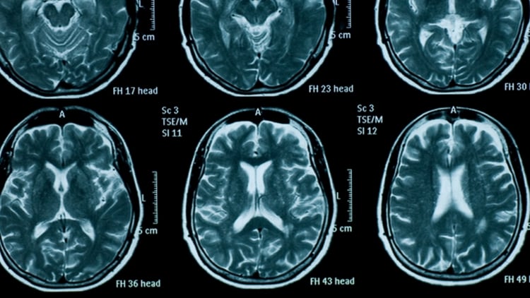 GSK, Sanofi, Denali take part in FNIH Parkinson’s biomarker project