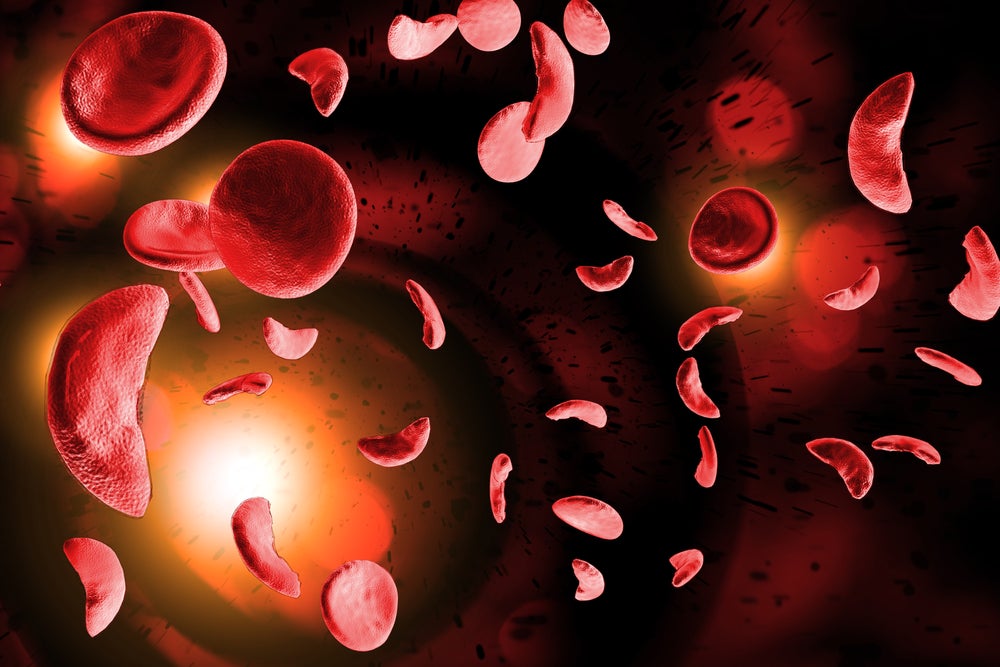 Editas grabs orphan drug status for sickle cell disease CRISPR therapy