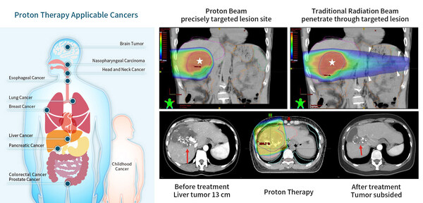 Chang Gung Cancer Proton Therapy Achieves Breakthrough