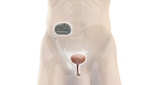 UroMems Initiates First-in-Human Study of Its Smart Implant to Treat Stress Urinary Incontinence