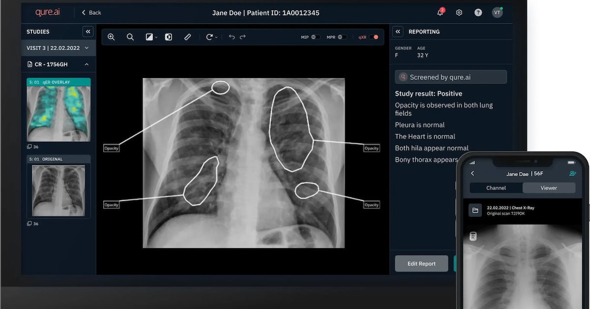 Qure.ai pursuing large AI with $65M Series D funding and more briefs