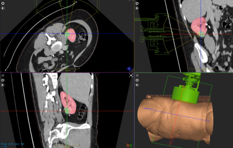 World’s First Kidney Tumor Treated Using the HistoSonics’ Edison® Histotripsy System