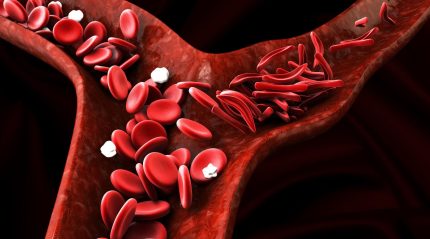 MHRA revokes Novartis’ Adakveo authorisation for sickle cell disease